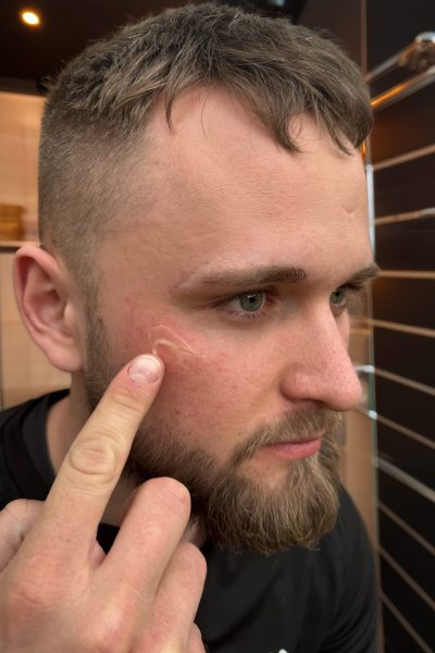 a man pointing at a scratch on his face